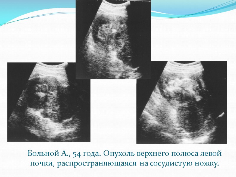 Больной А., 54 года. Опухоль верхнего полюса левой почки, распространяющаяся на сосудистую ножку.